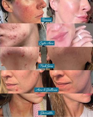 Before & after photos of skin conditions with labels including Rosacea, Cystic Acne, Nickles, Acne & Dullness, and Dermatitis. Darlin' Skincare Tallow & Tansy Balm